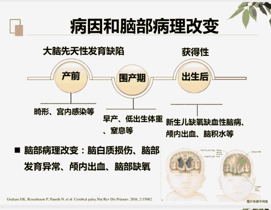 脑瘫儿童的康复治疗（一、定义与检查）